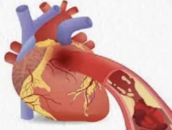 默沙东被低估的“王牌”？“坏胆固醇”克星催生百亿美元规模市场